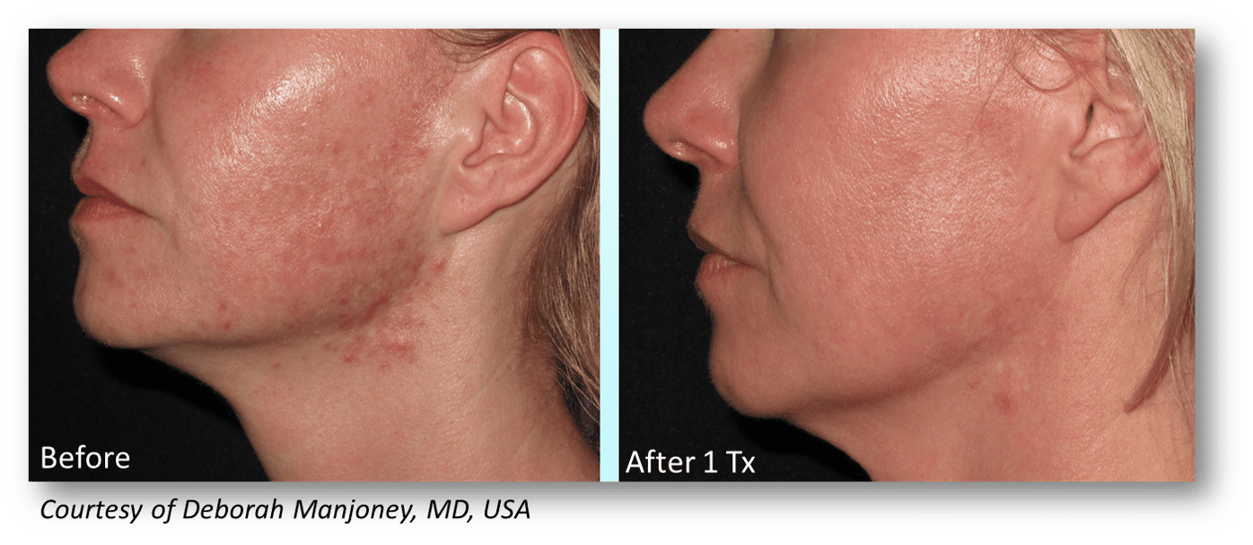 Microneedling - Skincare procedure for anti aging - Kattine Aesthetics | Murfreesboro, TN