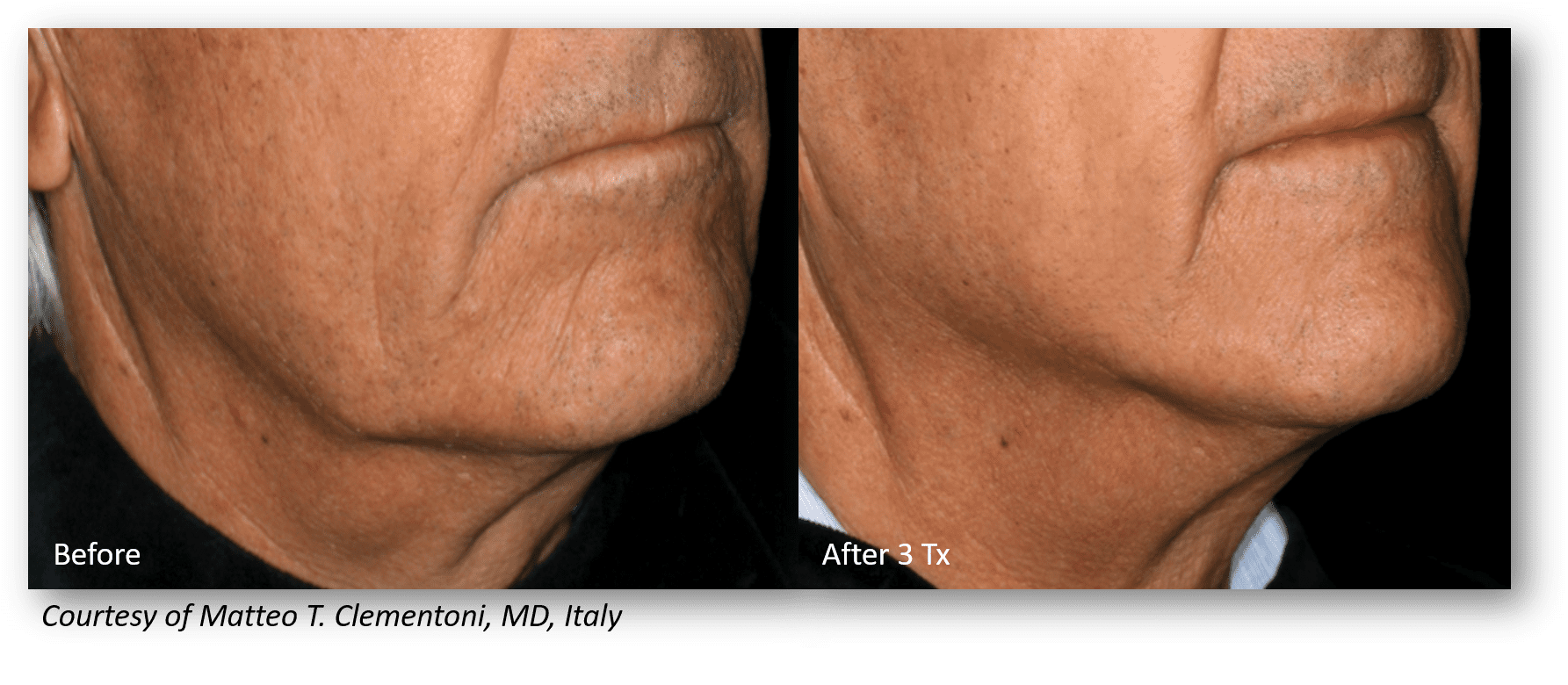 Microneedling Resurfacing Skincare - Anti aging - Juvederm - Kattine Aesthetics | Murfreesboro, TN