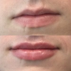 juvederm ultra lips - Kattine Aesthetics