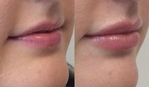 versa lip filler2 - Kattine Aesthetics